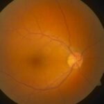 Clinical eye photograph illustrating Tubulointerstitial Nephritis Uveitis Tinu Syndrome