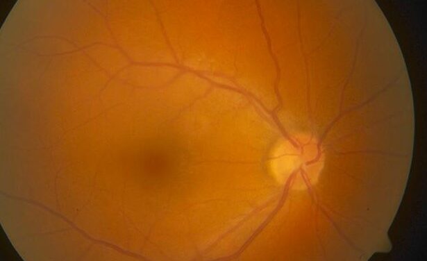 TINU Syndrome: The Uveitis That Follows a Kidney Workup