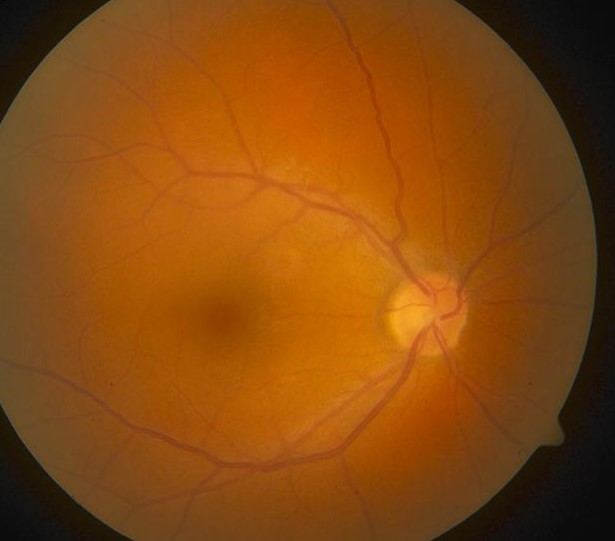 TINU Syndrome: The Uveitis That Follows a Kidney Workup