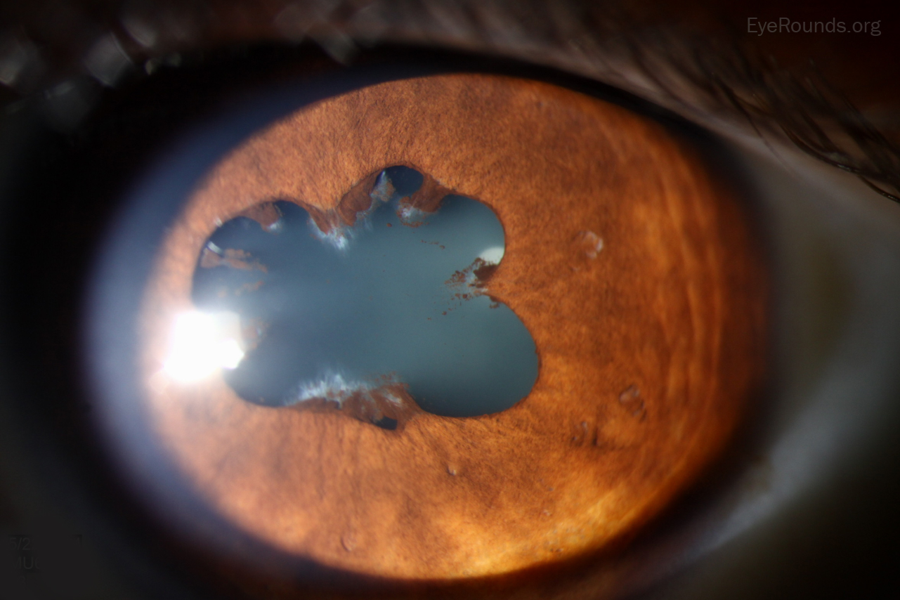 Clinical eye photograph illustrating Tubulointerstitial Nephritis Uveitis Tinu Syndrome