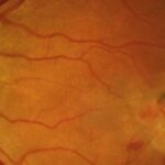 Clinical eye photograph illustrating Type 2 Macular Telangiectasia