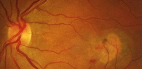 Type 2 Macular Telangiectasia: A Neurodegenerative Disease That Happens to Show Up in the Macula