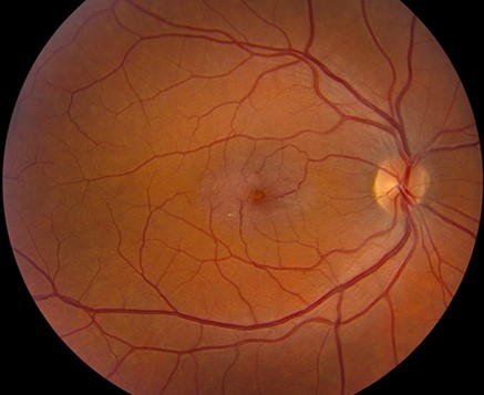 Clinical eye photograph illustrating Type 2 Macular Telangiectasia