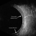 Clinical eye photograph illustrating Uveal Effusion Syndrome Nanophthalmic Eye