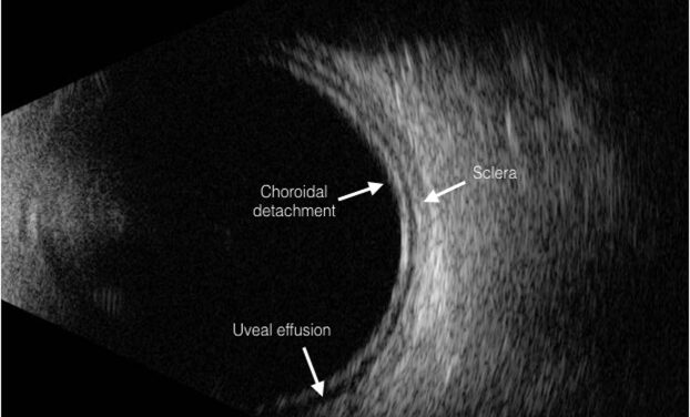 Uveal Effusion Syndrome: When a Detachment Has No Break and No Obvious Cause