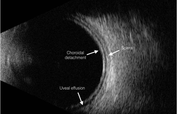Uveal Effusion Syndrome: When a Detachment Has No Break and No Obvious Cause