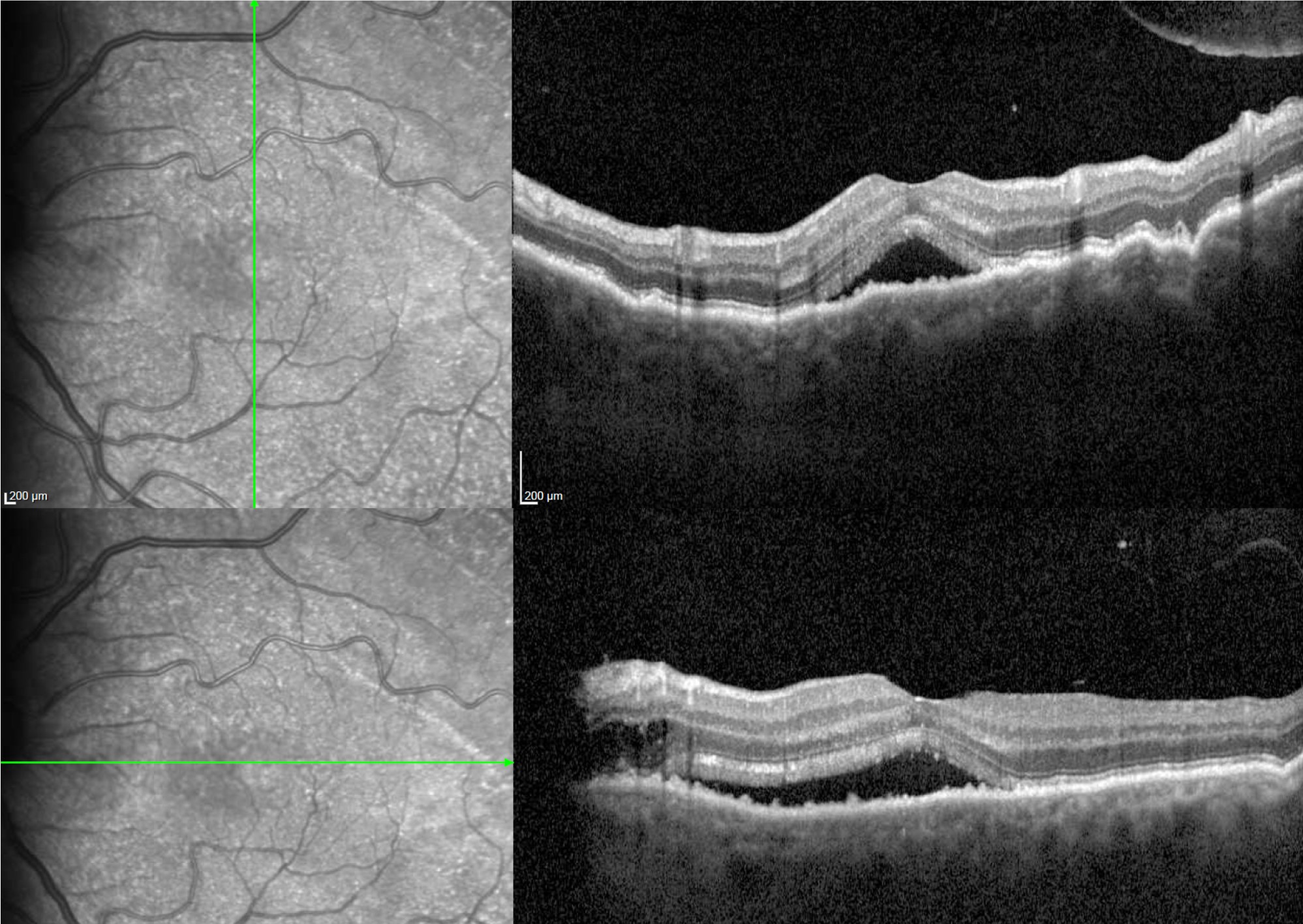 Clinical eye photograph illustrating Uveal Effusion Syndrome Nanophthalmic Eye
