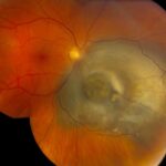 Clinical eye photograph illustrating Uveal Melanoma Prognostic Testing