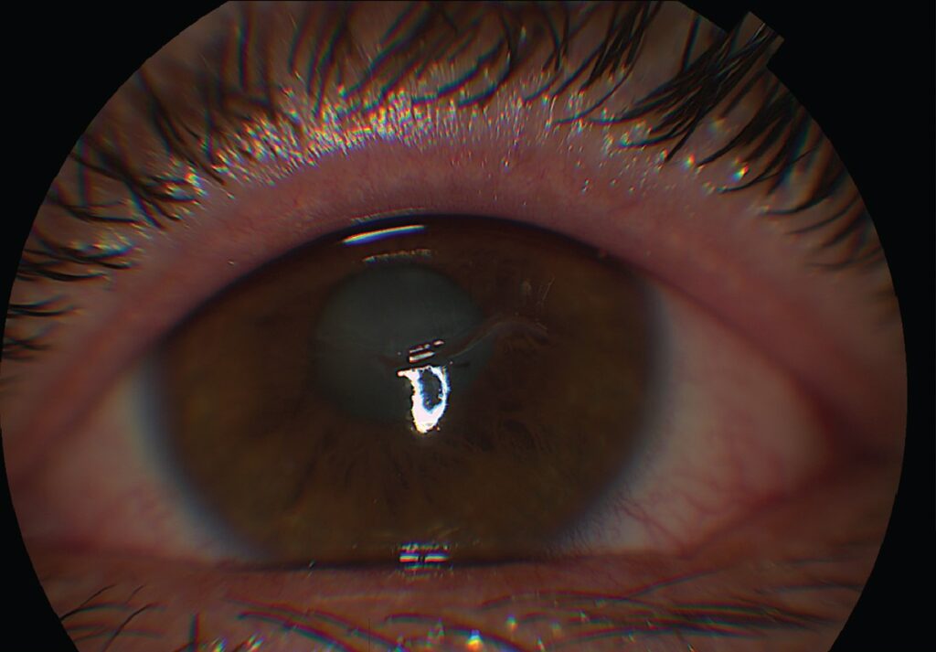 Clinical image illustrating Uveitis Testing (figure 1)