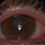 Clinical image illustrating Uveitis Testing (figure 1)
