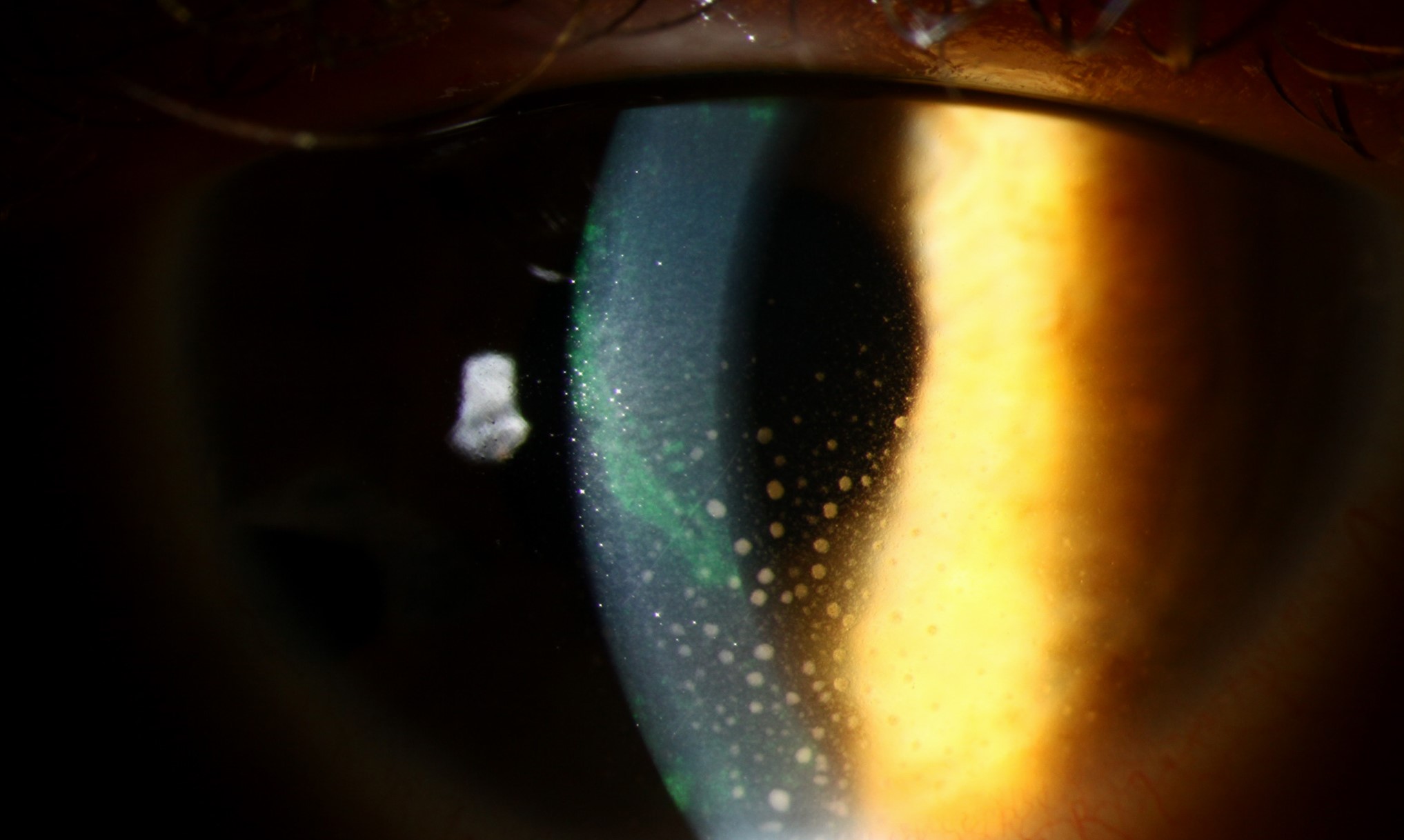 Clinical image illustrating Uveitis Testing (figure 2)