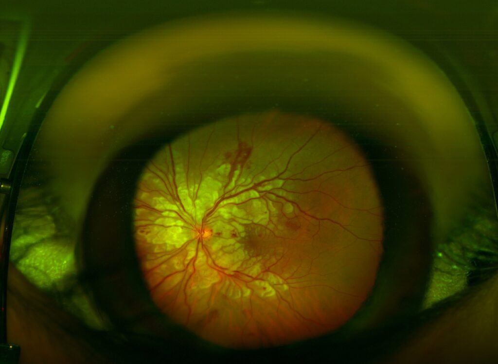 Clinical image illustrating Van Herick Test (Limbal Chamber Depth)