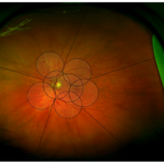 Clinical eye photograph illustrating Venous Beading Diabetic Retinopathy