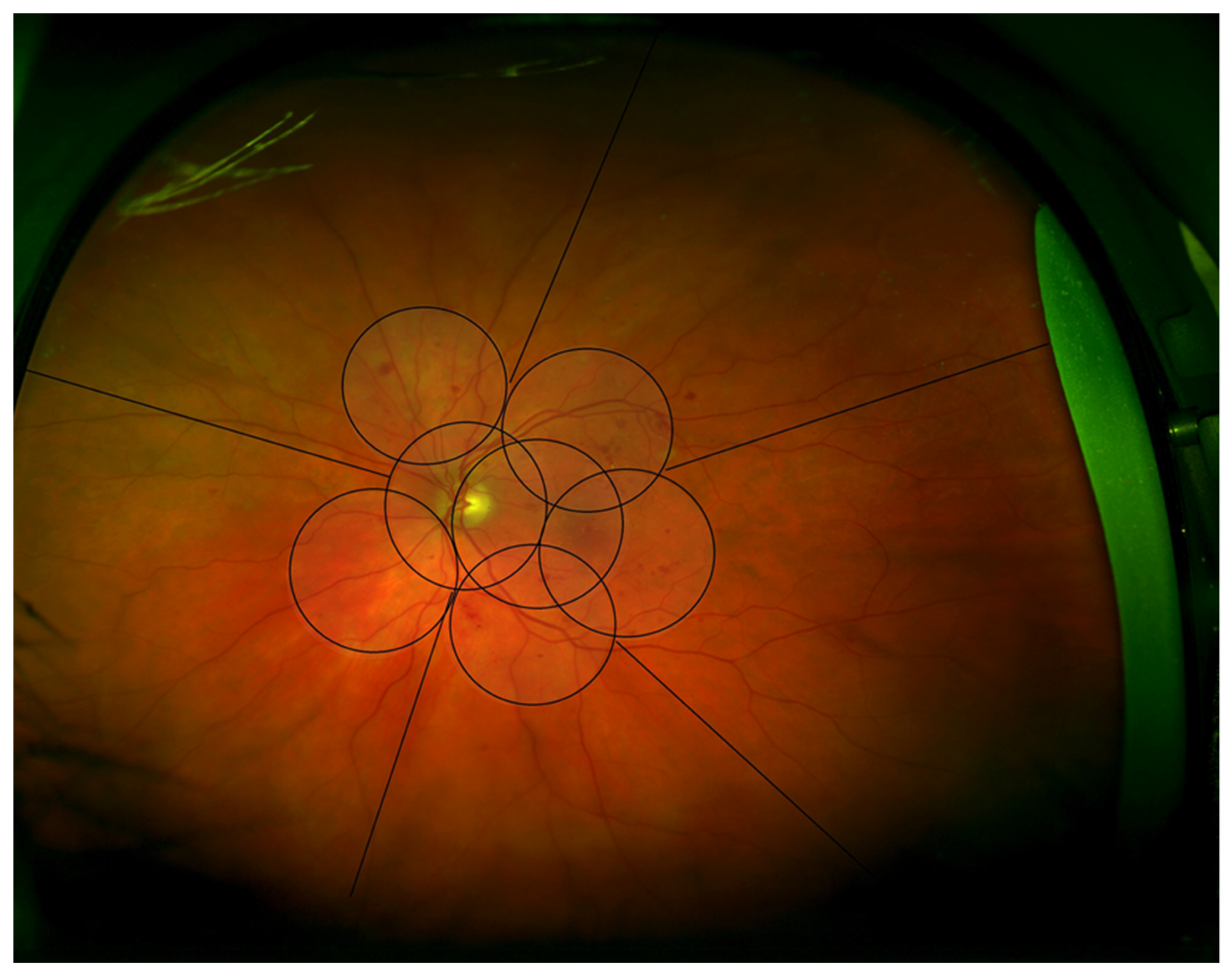 Venous Beading in Diabetic Retinopathy: Signs and Risk