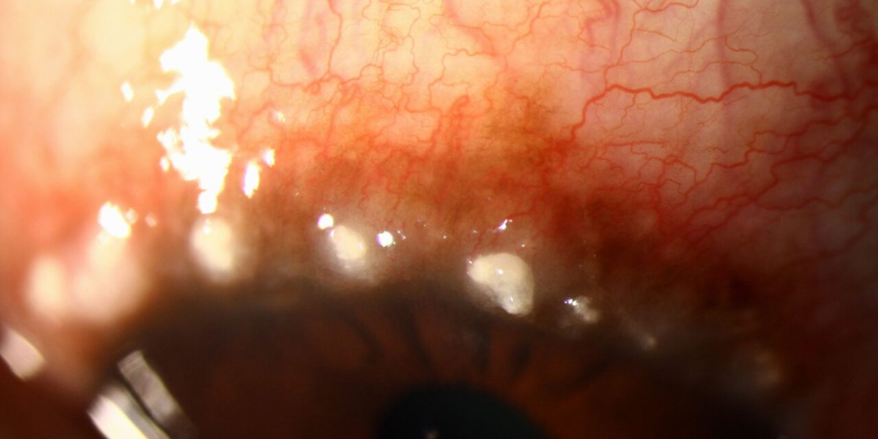 Limbal Vernal Keratoconjunctivitis: Horner-Trantas Dots and a Different Pattern of Severe Allergy