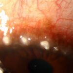 Clinical eye photograph illustrating Vernal Keratoconjunctivitis Limbal Form