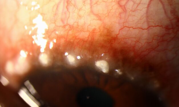Limbal Vernal Keratoconjunctivitis: Horner-Trantas Dots and a Different Pattern of Severe Allergy