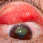 Clinical eye photograph illustrating Vernal Keratoconjunctivitis Tarsal Giant Papillae