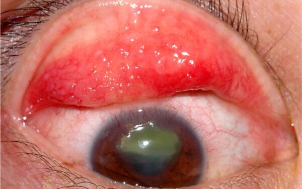 Vernal Keratoconjunctivitis: Reading the Giant Papillae and Knowing When the Cornea Is at Risk