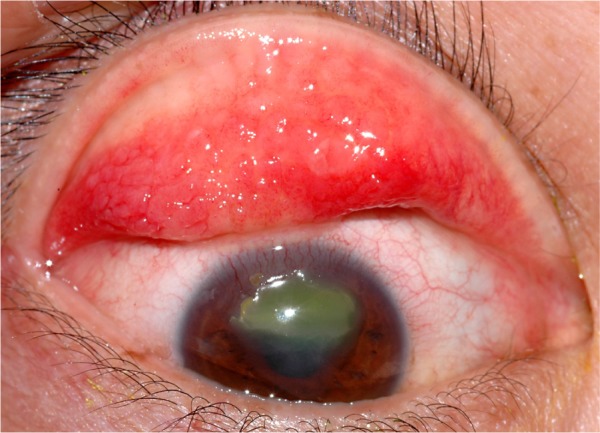Clinical eye photograph illustrating Vernal Keratoconjunctivitis Tarsal Giant Papillae