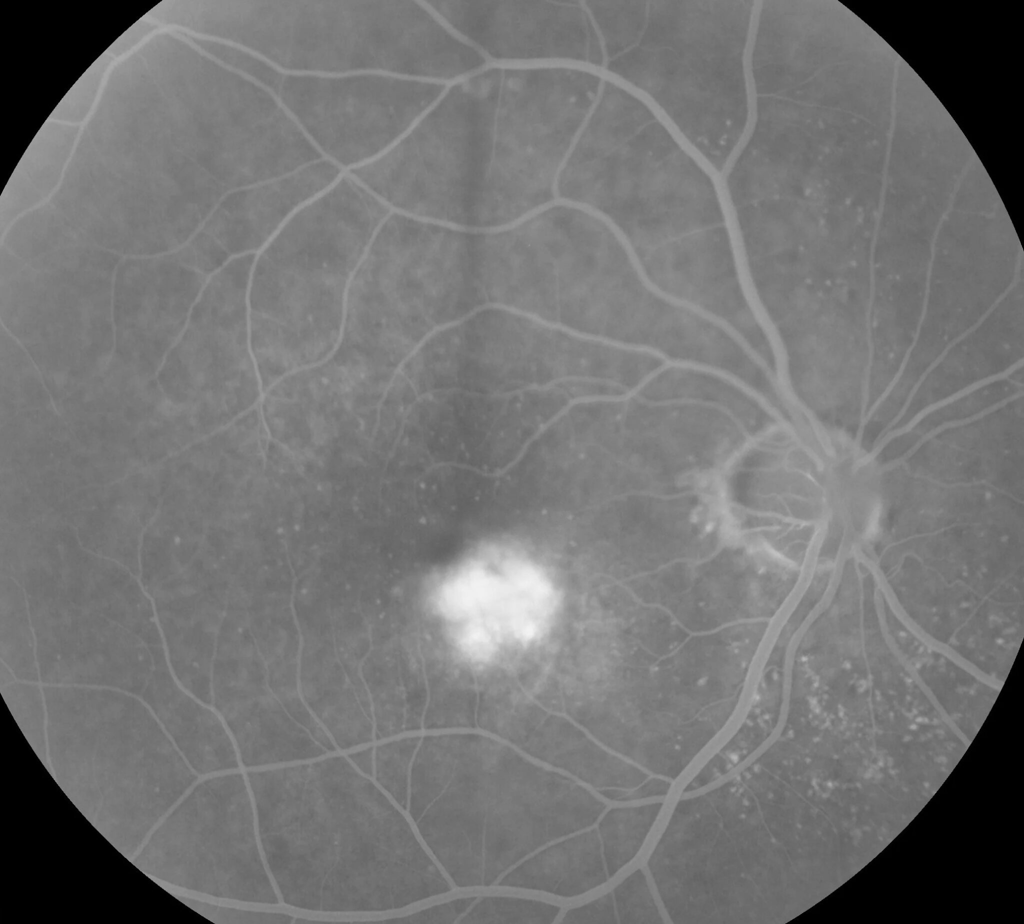 VIEW Trials: Aflibercept Every Eight Weeks in AMD