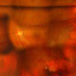 Clinical eye photograph illustrating Vitrectomy Complications