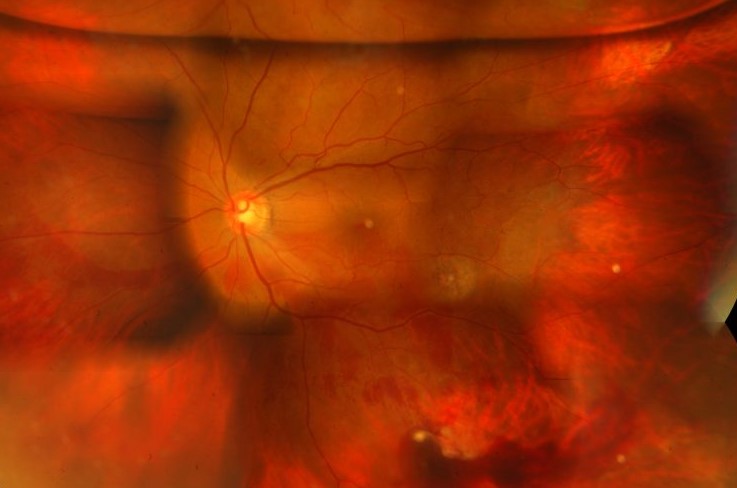 Vitrectomy Complications: What Goes Wrong, When It Appears, and How to Respond