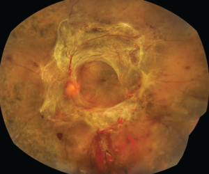 Clinical eye photograph illustrating Vitrectomy for Diabetic Retinopathy