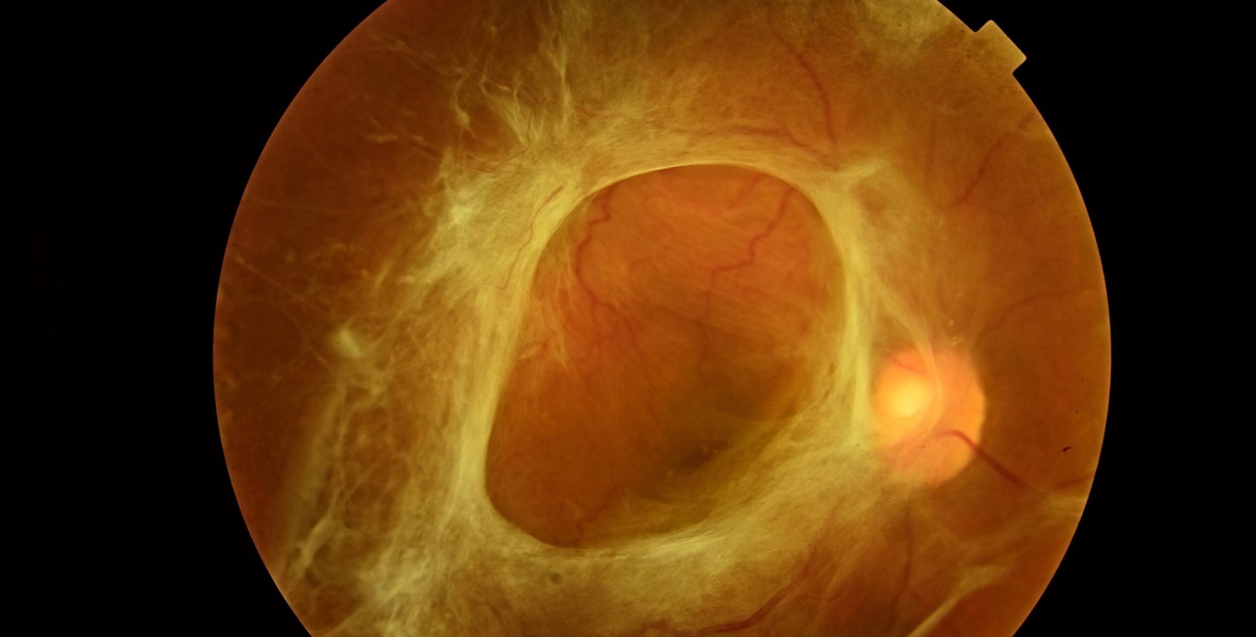Clinical eye photograph illustrating Vitrectomy for Diabetic Retinopathy