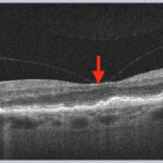 Clinical eye photograph illustrating Vitreomacular Adhesion