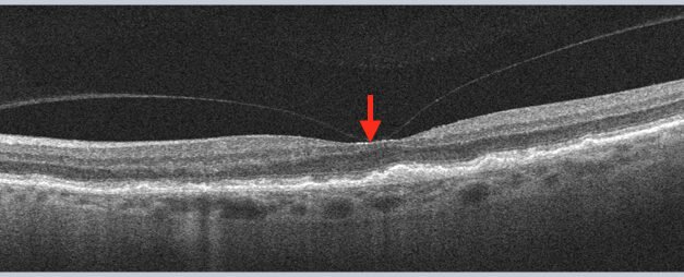 Vitreomacular Adhesion: The Sticky Interface That May or May Not Cause Trouble