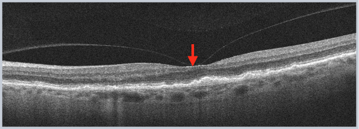 Vitreomacular Adhesion: The Sticky Interface That May or May Not Cause Trouble