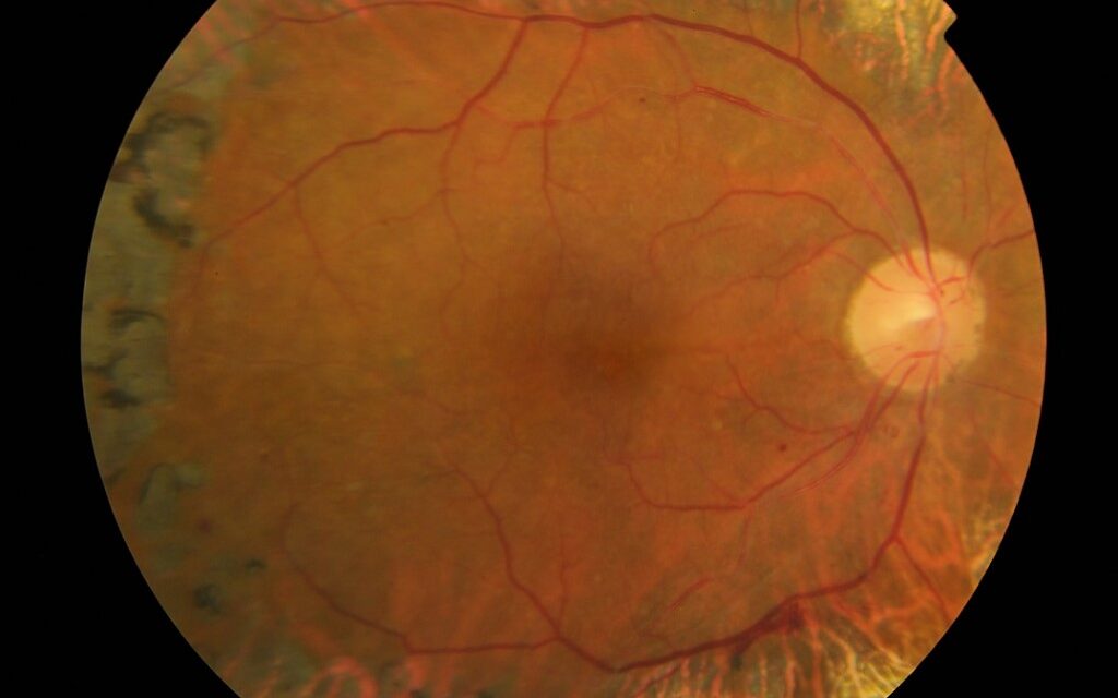 Vitreoretinal Traction Syndrome: When the Vitreous Won’t Let the Macula Go