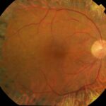 Clinical eye photograph illustrating Vitreoretinal Traction Syndrome
