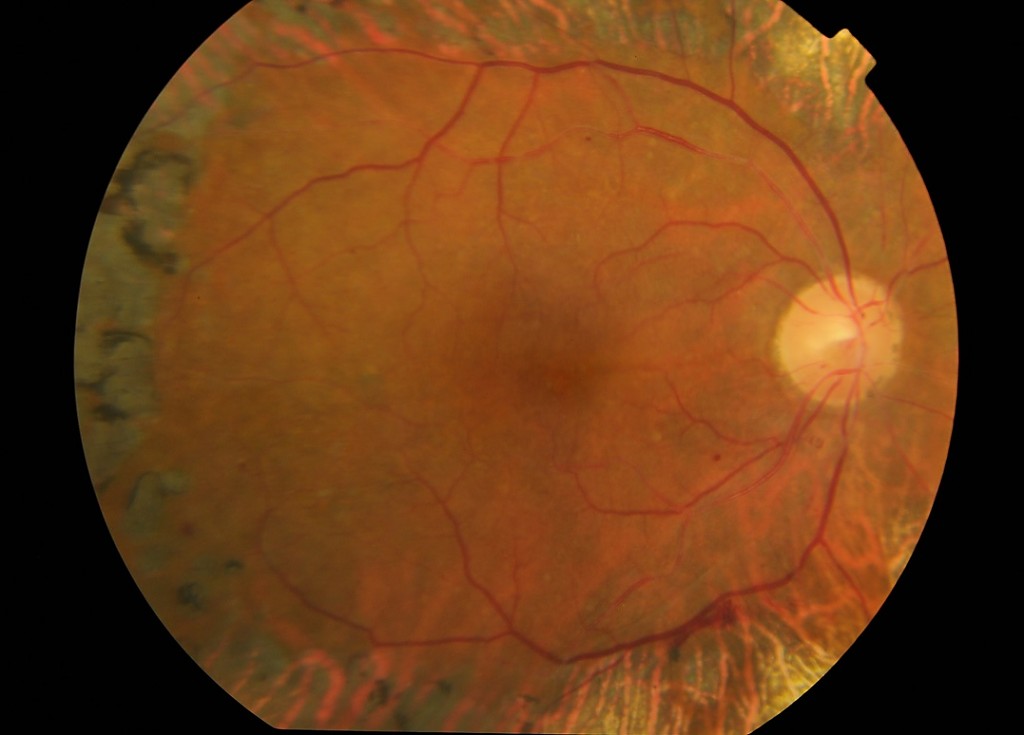 Clinical eye photograph illustrating Vitreoretinal Traction Syndrome