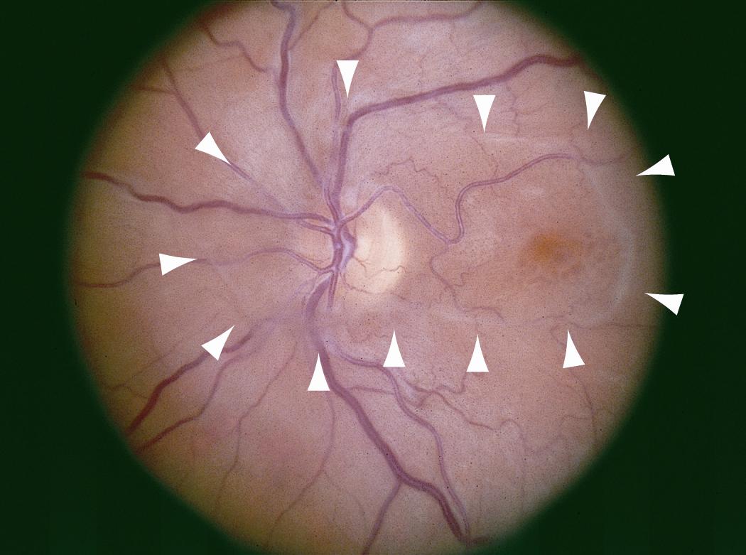 Clinical eye photograph illustrating Vitreoretinal Traction Syndrome