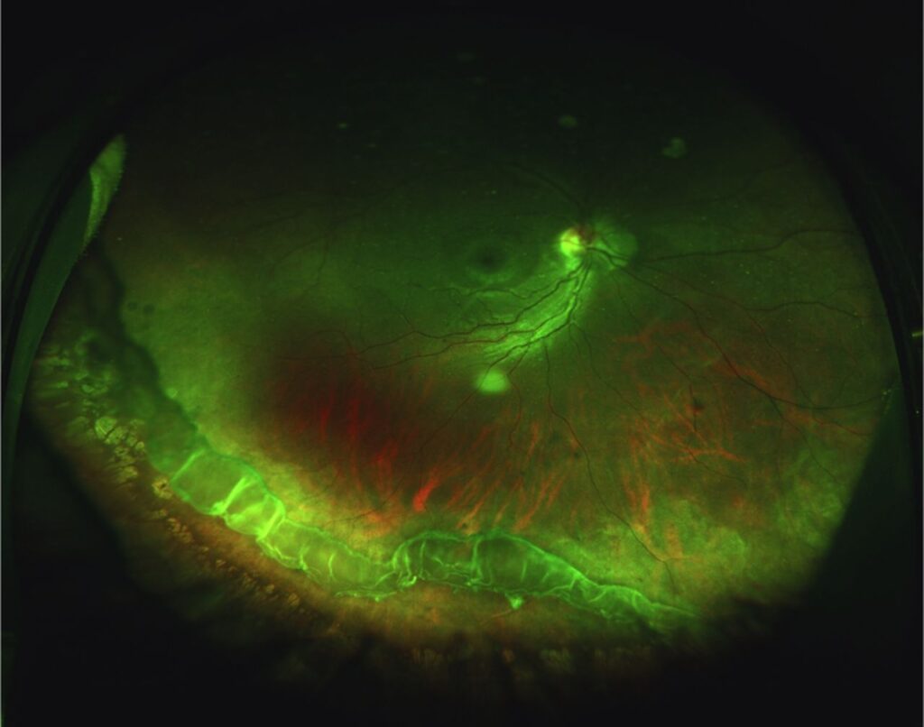 Clinical eye photograph illustrating Vitreous Base Avulsion Trauma