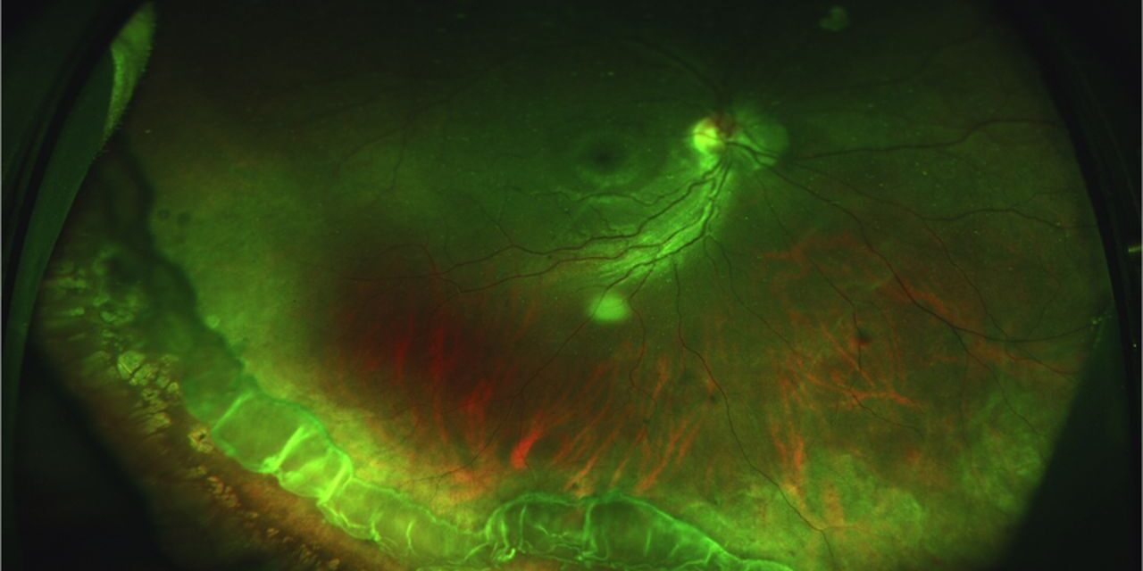 Vitreous Base Avulsion: A Trauma Sign With Its Own Bucket-Handle Shape