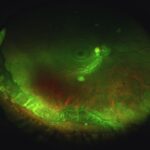 Clinical eye photograph illustrating Vitreous Base Avulsion Trauma