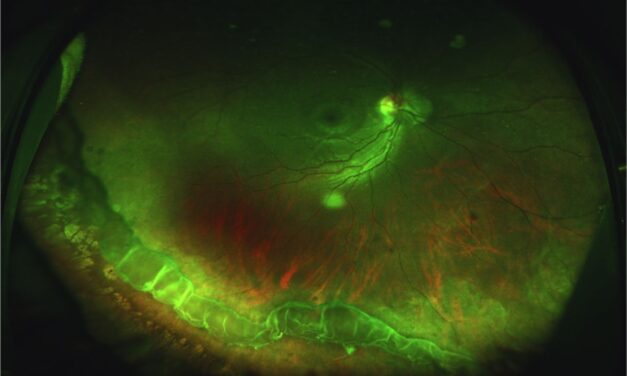 Vitreous Base Avulsion: A Trauma Sign With Its Own Bucket-Handle Shape