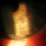 Clinical eye photograph illustrating Vitreous Shafer Sign Tobacco Dust