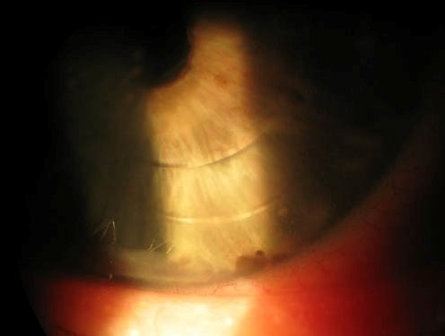 Shafer Sign: What Tobacco Dust in the Vitreous Is Really Telling You