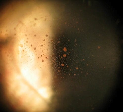 Clinical eye photograph illustrating Vitreous Shafer Sign Tobacco Dust
