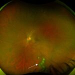 Clinical image illustrating Vitreous Snowballs (Snowball Opacities)