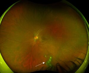 Clinical image illustrating Vitreous Snowballs (Snowball Opacities)