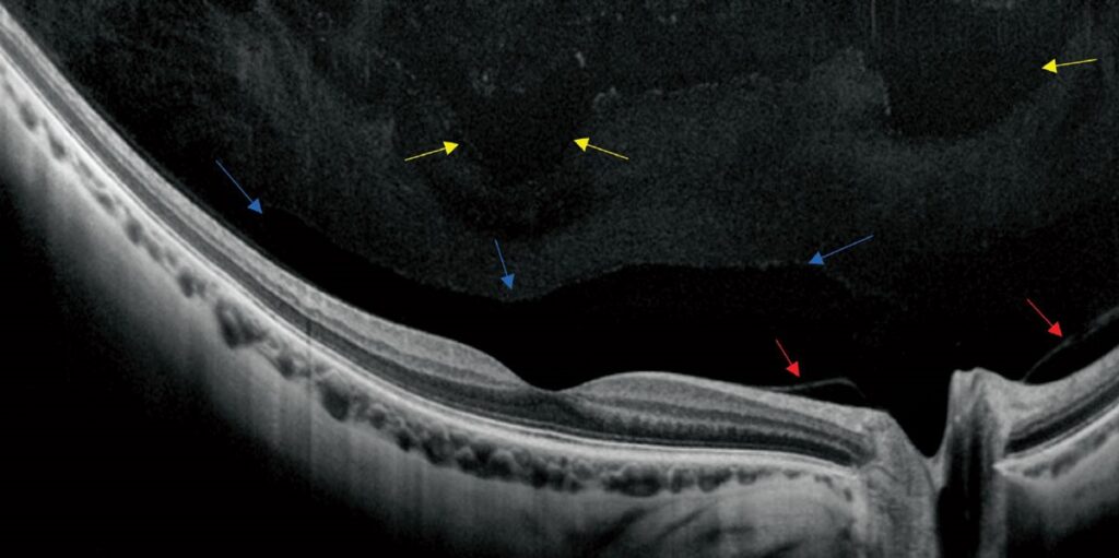 Clinical image illustrating Vitreous Structure, Composition and Aging
