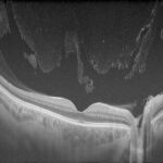 Clinical eye photograph illustrating Vitreous Syneresis