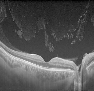Vitreous Syneresis: Why the Vitreous Liquefies and When Floaters Need a Closer Look