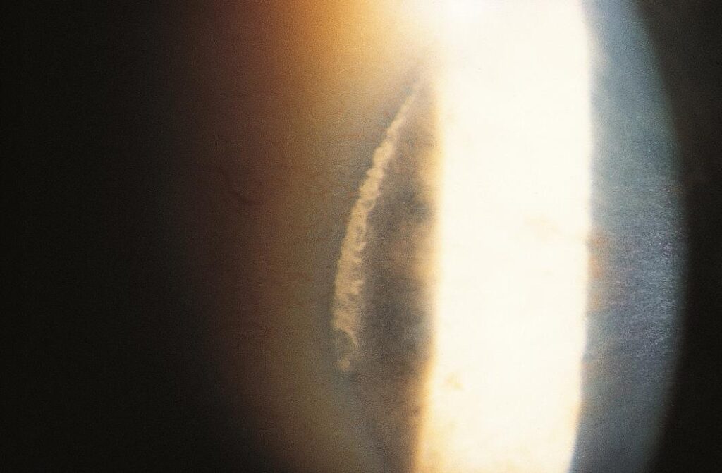Clinical eye photograph illustrating Vogt Limbal Girdle