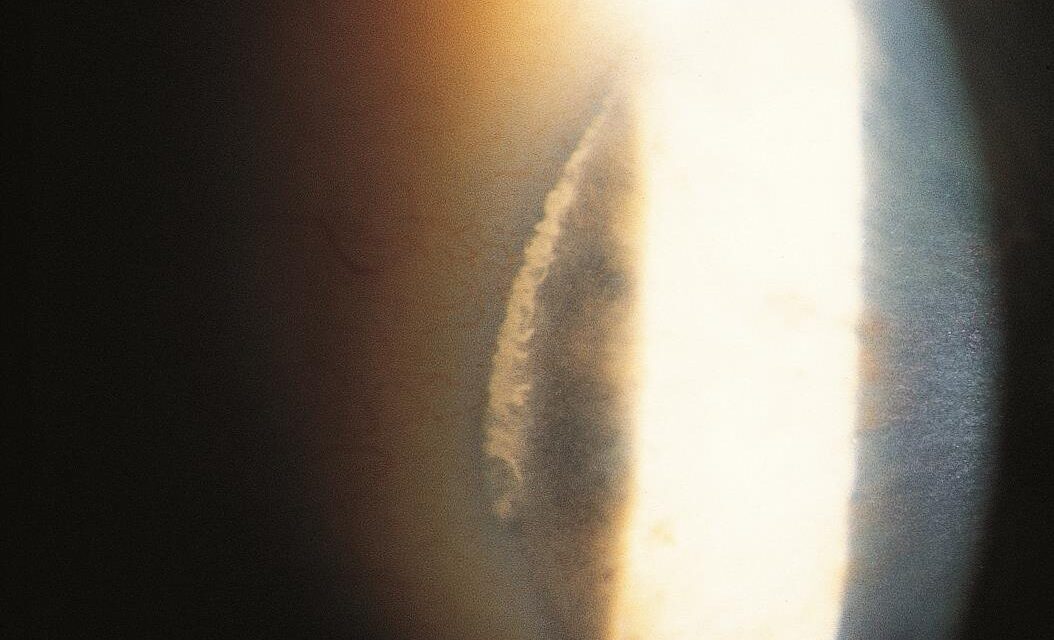 White Limbal Girdle of Vogt: The Chalky Crescent at the Limbus That Is Often Mistaken for Arcus